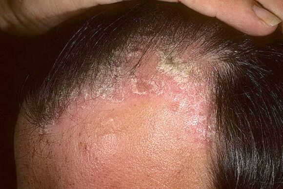 Psoriasis -Symptome