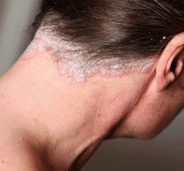 Wie man Psoriasis behandelt