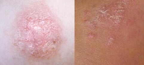 Psoriasis im Anfangsstadium