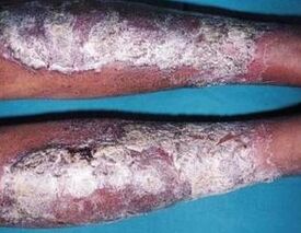 Salbe aus Psoriasis